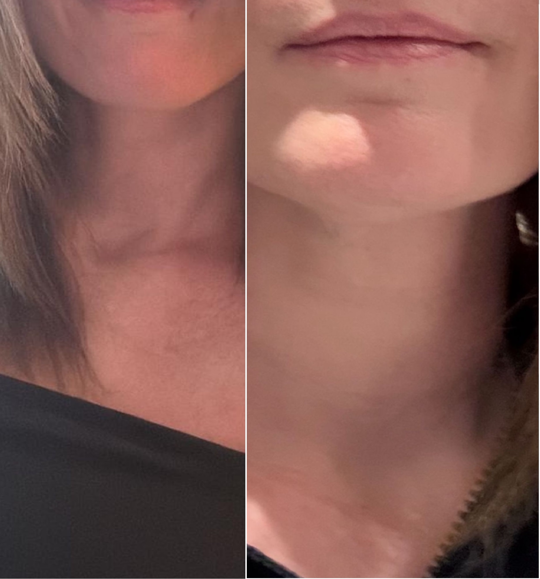 nachher-bild_rf_microneedling_1.jpg nachher-bild_rf_microneedling_1.jpg